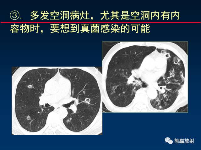 【PPT】肺曲霉菌病：放射科医生如何应对