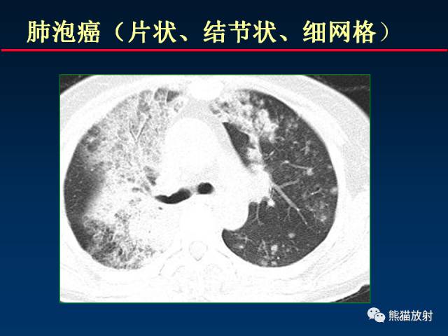 【PPT】肺曲霉菌病：放射科医生如何应对