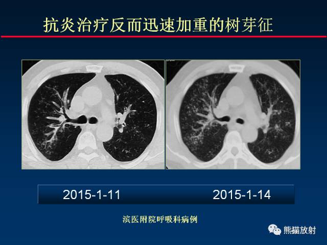 【PPT】肺曲霉菌病：放射科医生如何应对