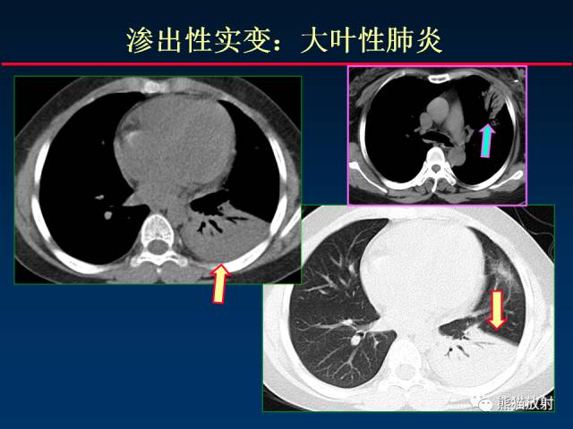 【PPT】肺曲霉菌病：放射科医生如何应对