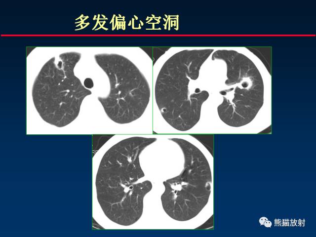 【PPT】肺曲霉菌病：放射科医生如何应对