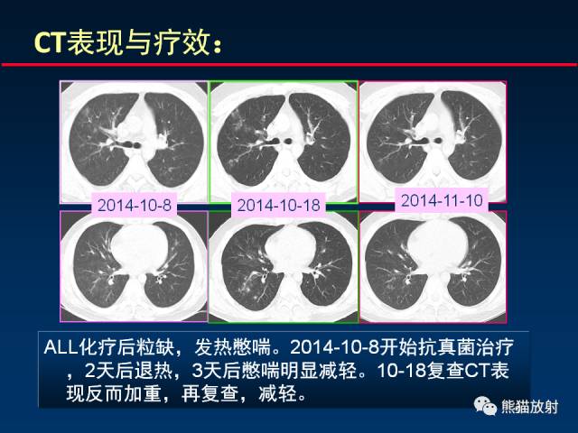 【PPT】肺曲霉菌病：放射科医生如何应对