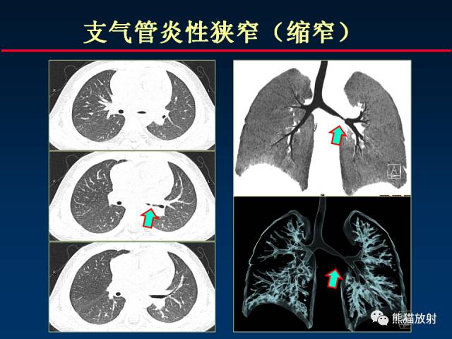 【PPT】肺曲霉菌病：放射科医生如何应对