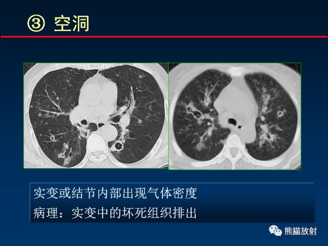 【PPT】肺曲霉菌病：放射科医生如何应对