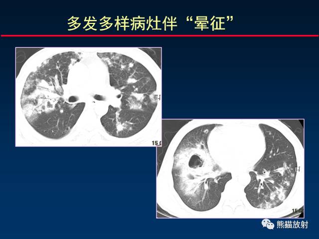 【PPT】肺曲霉菌病：放射科医生如何应对