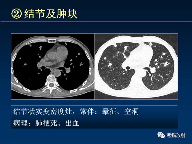 【PPT】肺曲霉菌病：放射科医生如何应对