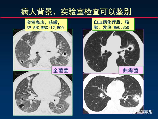 【PPT】肺曲霉菌病：放射科医生如何应对