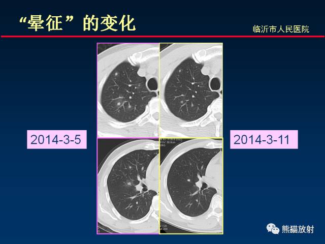 【PPT】肺曲霉菌病：放射科医生如何应对