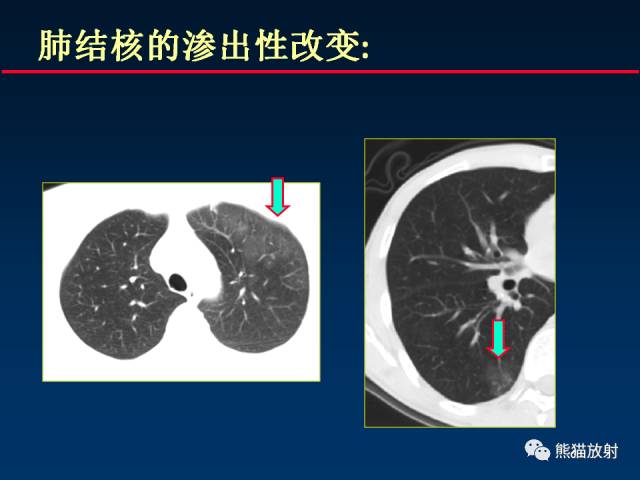 【PPT】肺曲霉菌病：放射科医生如何应对