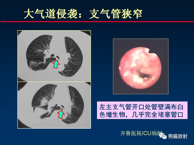【PPT】肺曲霉菌病：放射科医生如何应对