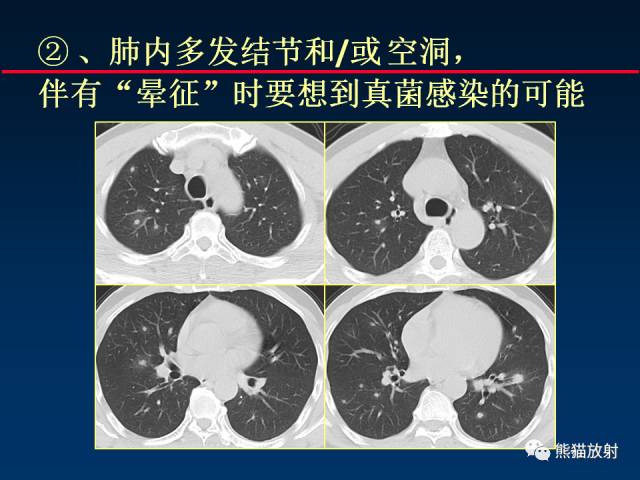【PPT】肺曲霉菌病：放射科医生如何应对