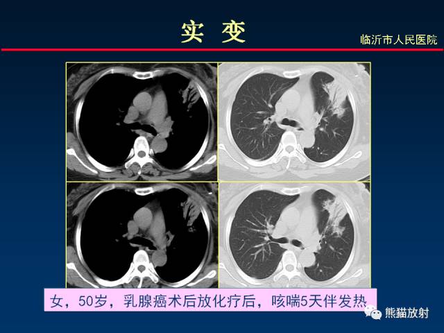 【PPT】肺曲霉菌病：放射科医生如何应对