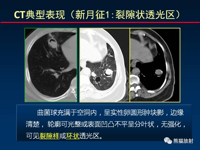 【PPT】肺曲霉菌病：放射科医生如何应对
