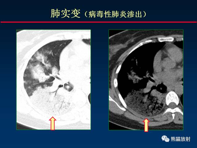 【PPT】肺曲霉菌病：放射科医生如何应对