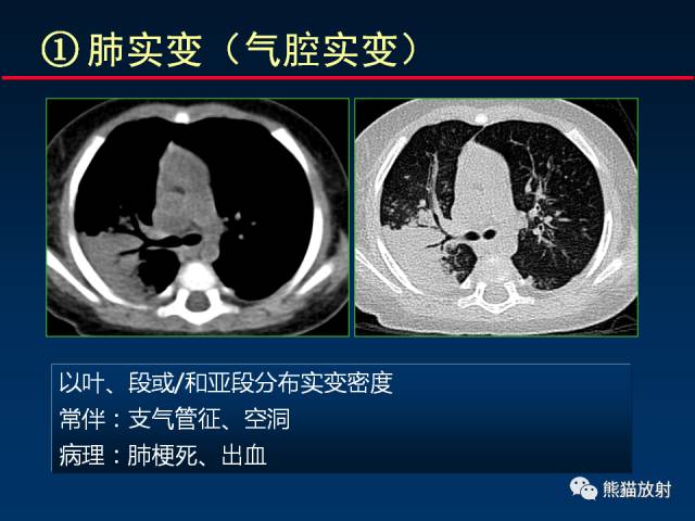 【PPT】肺曲霉菌病：放射科医生如何应对