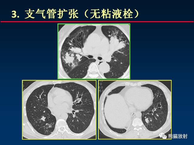 【PPT】肺曲霉菌病：放射科医生如何应对