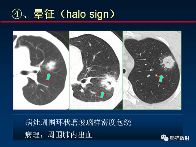 【PPT】肺曲霉菌病：放射科医生如何应对