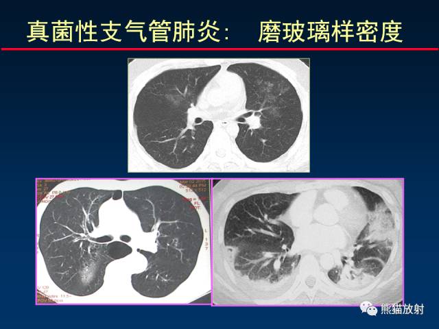 【PPT】肺曲霉菌病：放射科医生如何应对