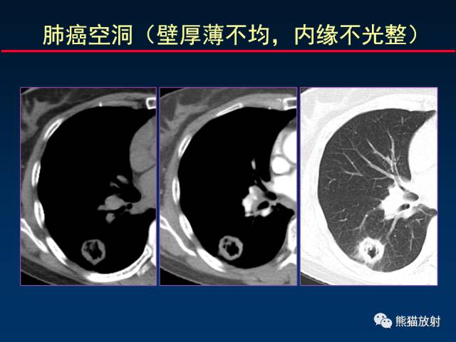 【PPT】肺曲霉菌病：放射科医生如何应对