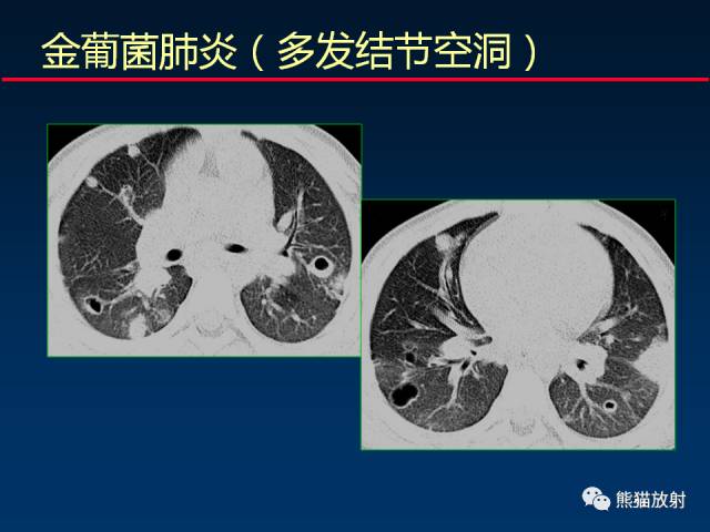 【PPT】肺曲霉菌病：放射科医生如何应对