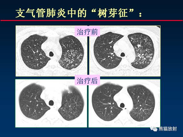 【PPT】肺曲霉菌病：放射科医生如何应对