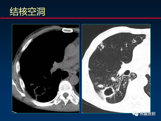 【PPT】肺曲霉菌病：放射科医生如何应对