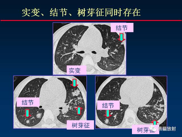 【PPT】肺曲霉菌病：放射科医生如何应对