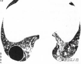 “空气潴留征” 的影像表现与临床意义
