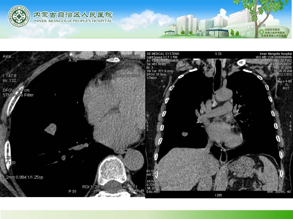 【病例】右肺下叶硬化性血管瘤1例CT