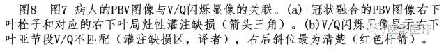 肺动脉高压的双能CT影像：挑战与机遇