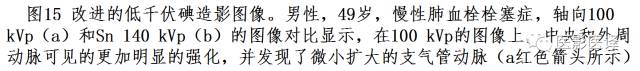 肺动脉高压的双能CT影像：挑战与机遇