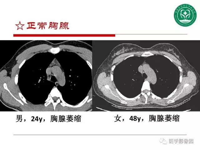 【PPT】纵隔肿瘤的影像检查规范及诊断思路