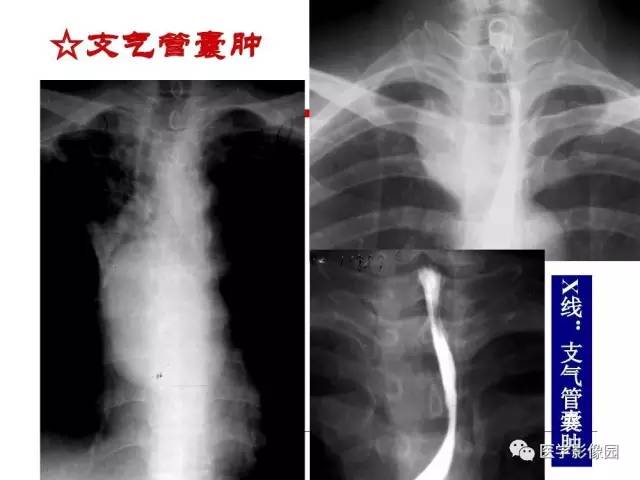 【PPT】纵隔肿瘤的影像检查规范及诊断思路