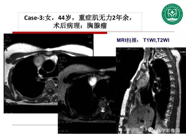 【PPT】纵隔肿瘤的影像检查规范及诊断思路