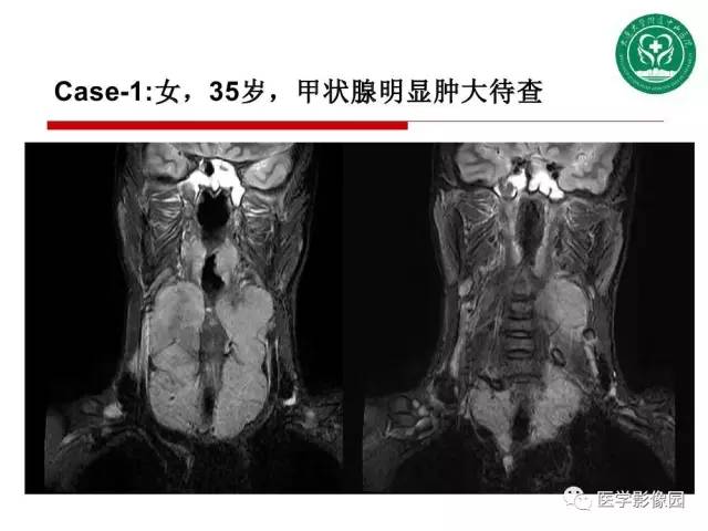 【PPT】纵隔肿瘤的影像检查规范及诊断思路