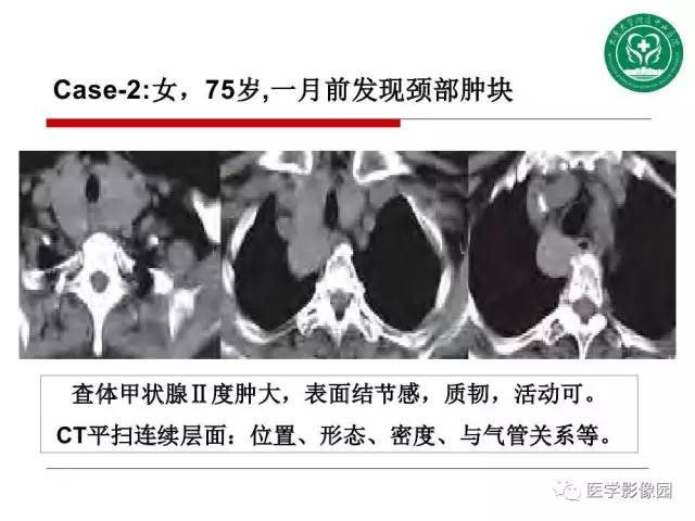 【PPT】纵隔肿瘤的影像检查规范及诊断思路