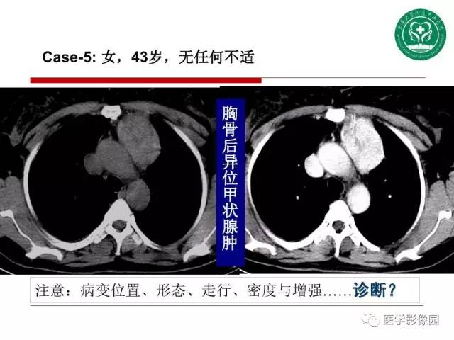 【PPT】纵隔肿瘤的影像检查规范及诊断思路