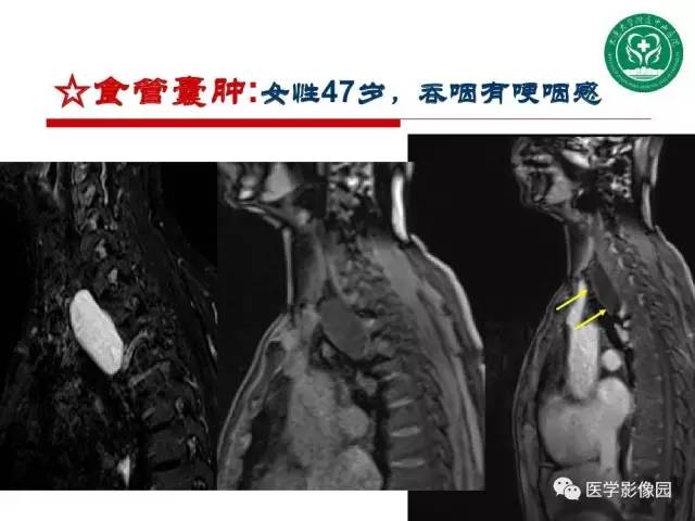 【PPT】纵隔肿瘤的影像检查规范及诊断思路