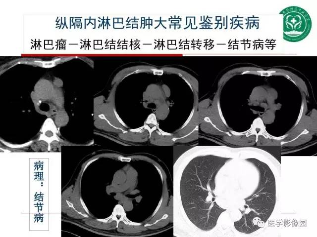 【PPT】纵隔肿瘤的影像检查规范及诊断思路