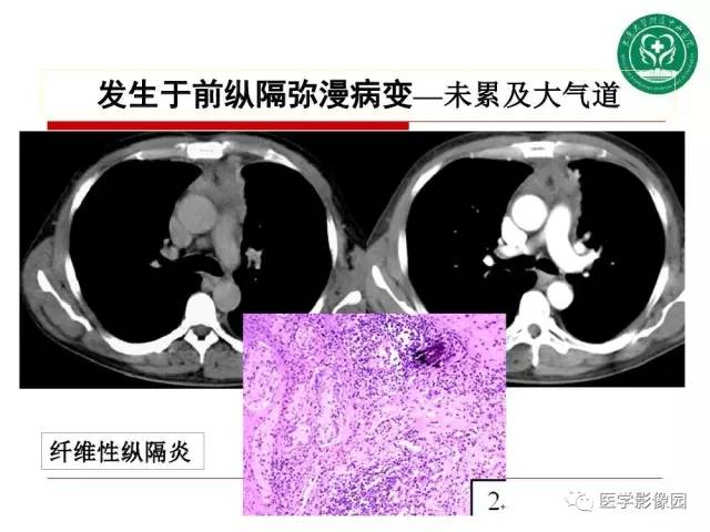 【PPT】纵隔肿瘤的影像检查规范及诊断思路