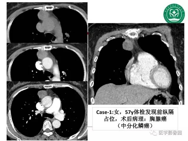 【PPT】纵隔肿瘤的影像检查规范及诊断思路