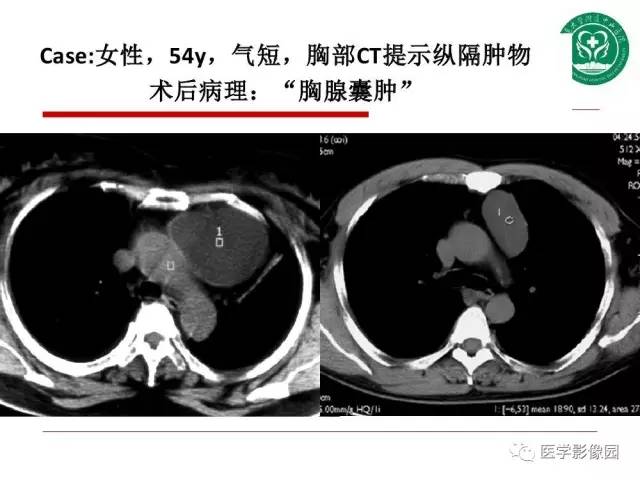 【PPT】纵隔肿瘤的影像检查规范及诊断思路