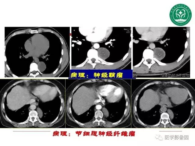 【PPT】纵隔肿瘤的影像检查规范及诊断思路