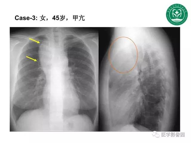 【PPT】纵隔肿瘤的影像检查规范及诊断思路