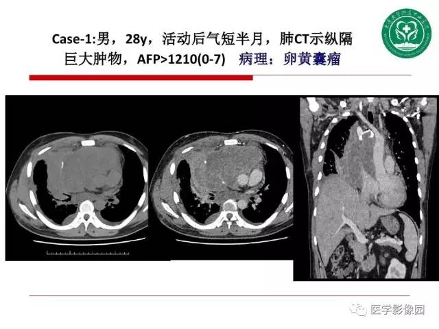 【PPT】纵隔肿瘤的影像检查规范及诊断思路