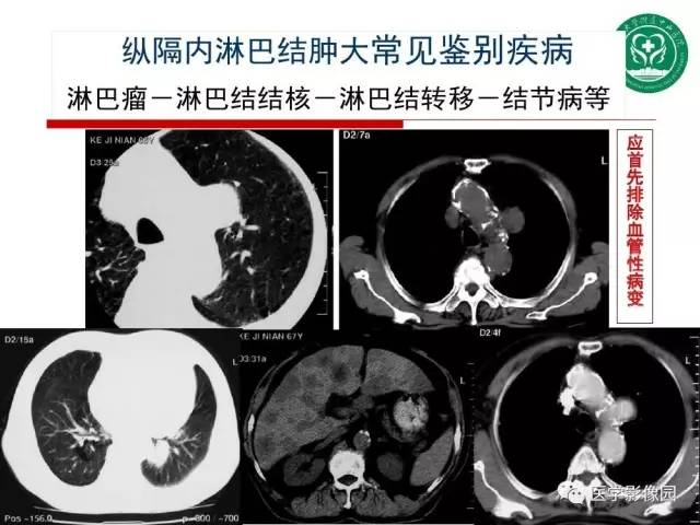 【PPT】纵隔肿瘤的影像检查规范及诊断思路