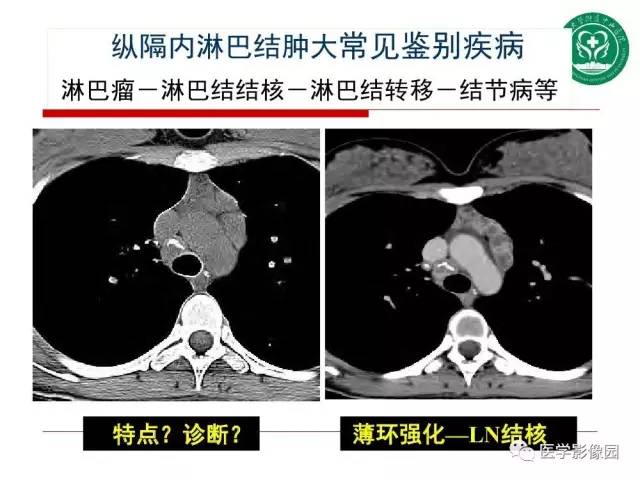 【PPT】纵隔肿瘤的影像检查规范及诊断思路