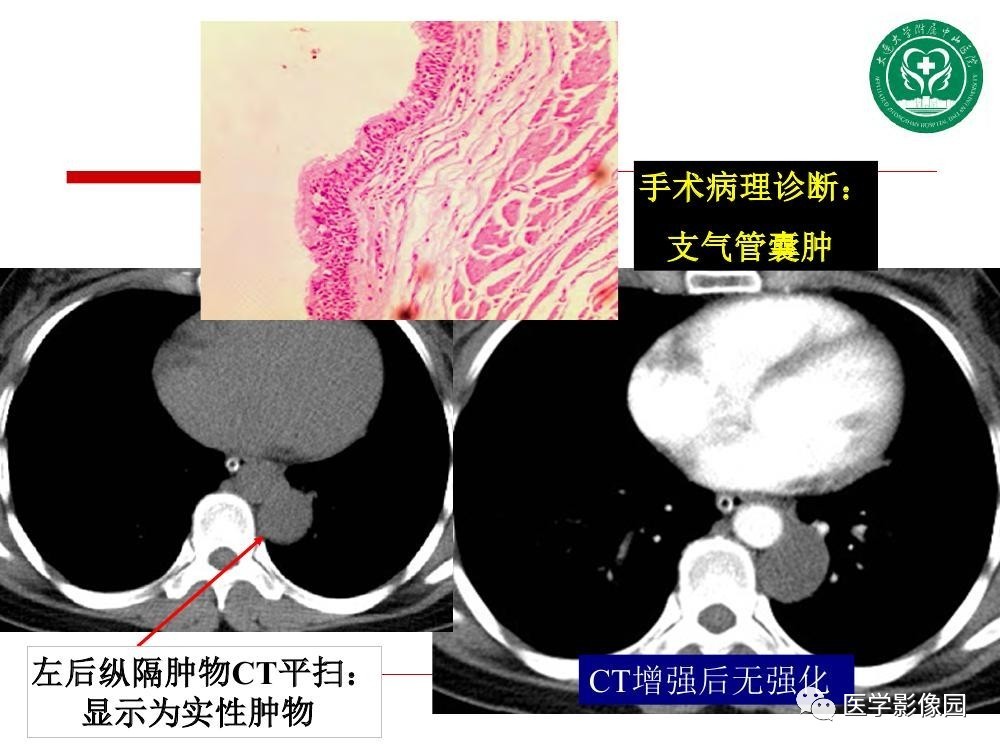 【PPT】纵隔肿瘤的影像检查规范及诊断思路