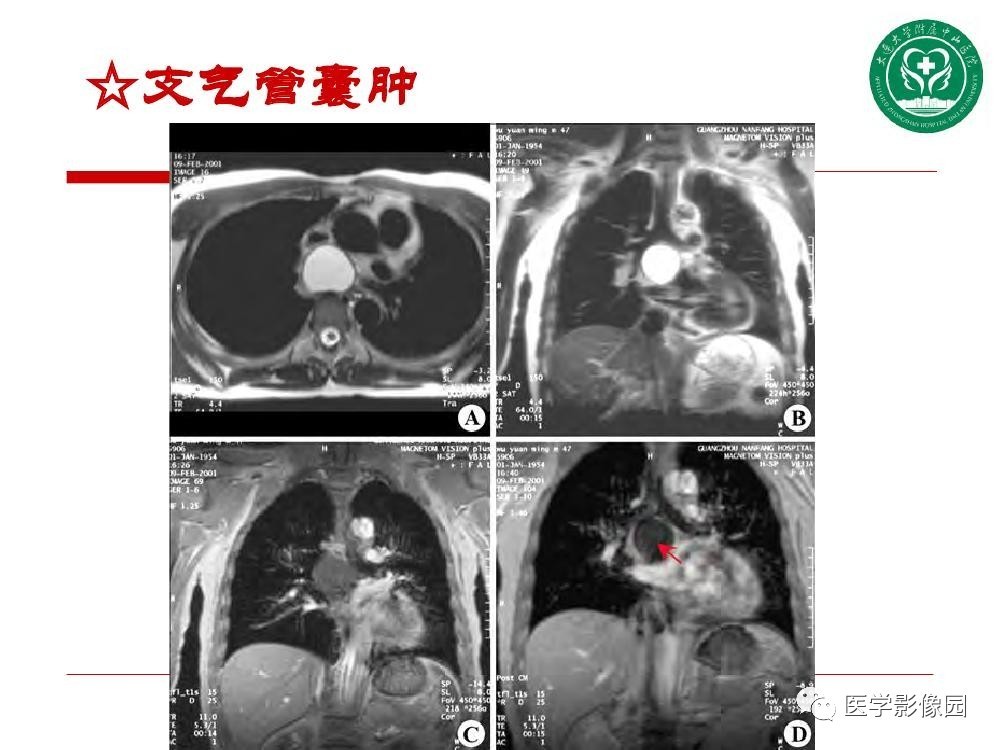 【PPT】纵隔肿瘤的影像检查规范及诊断思路