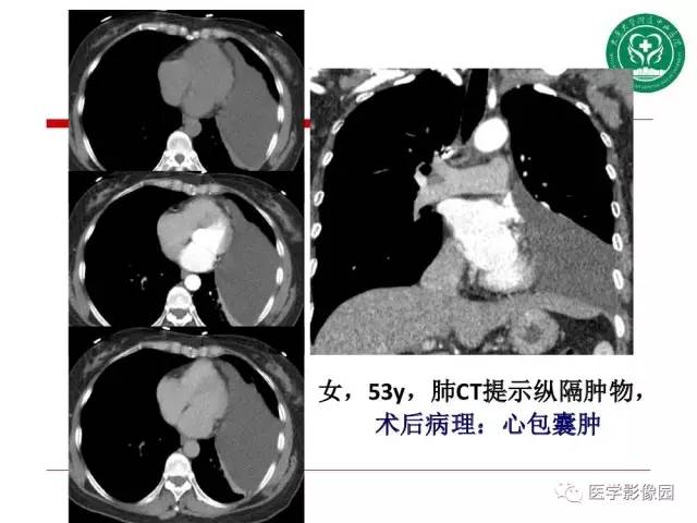 【PPT】纵隔肿瘤的影像检查规范及诊断思路